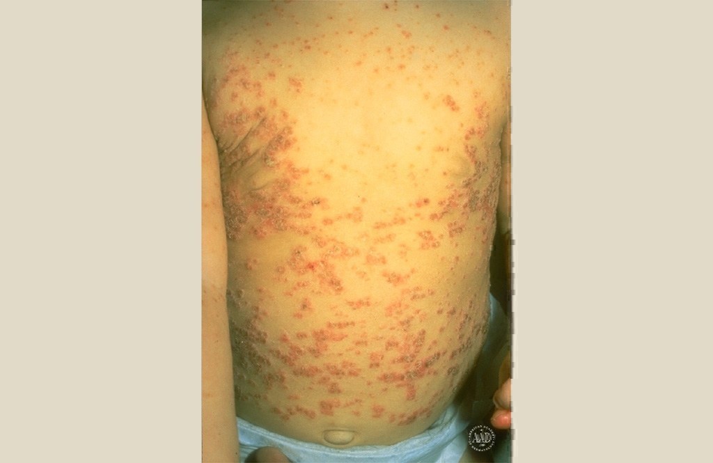What causes brown skin spots to turn red?